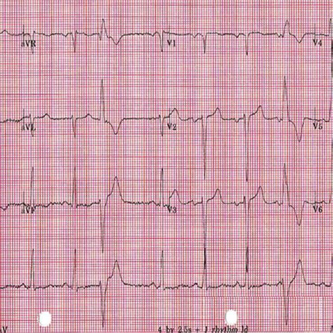 Twelve Lead Electrocardiogram Showing Sinus Rhythm With A Vertical Axis