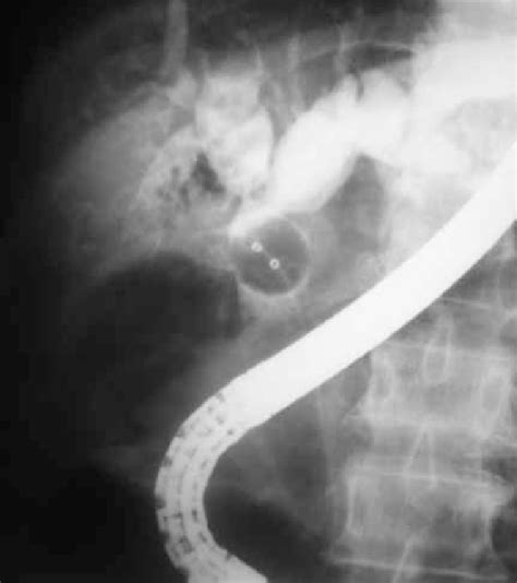 Ercp Balloon Cholangiogram Shows Complex Hilar Strictures With