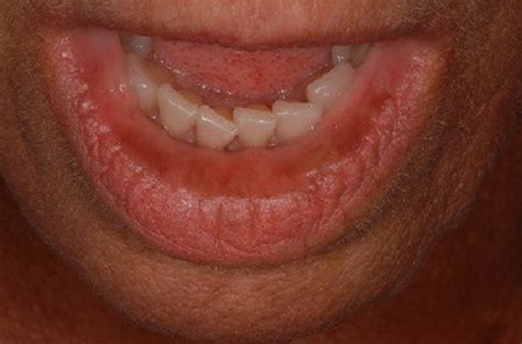 Lips Discoloration And Its Effect