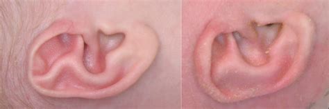 Newborn Ear Deformity Treatment Ear Molding Los Angeles Ent Surgeon