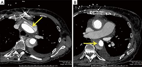 Intraoperative Descending Aortic Dissection During Aortic Root