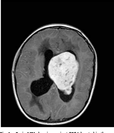 Figure 1 From Management Of Subependymal Giant Cell Astrocytoma Sega