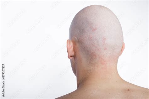 Bald Head Of A Man On A White Background Body Part The Head Concept