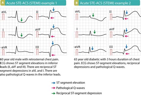 Classification Of Acute Coronary Syndromes Acs And Acute Myocardial
