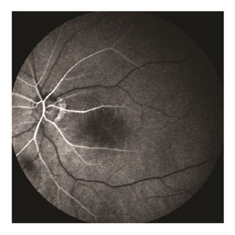 Acute Central Retinal Artery Occlusion Left Eye A Fundus