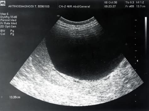 We did not find results for: Another view via ultrasonography of the patient's simple ...