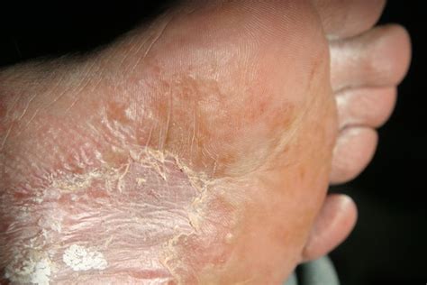 Urtikaria merupakan peradangan dan pembengkakan pada permukaan kulit. Jual Obat De Nature Asli: Obat Gatal Eksim Kering Di ...