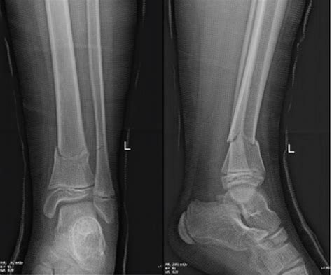 Distal Tibial Metaphyseal Fractures In Children Treatment By Intrafocal