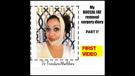 Buccal Fat Removal Journey Youtube