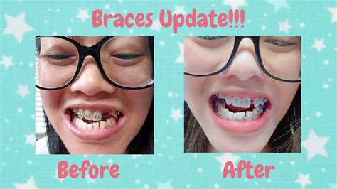 Sticky foods such as chewing gum or taffy can easily rip off braces, and should be avoided even after the pain is gone. Adult Braces | NEW UPDATE!!! | PONTIC TOOTH | BOTTOM ...