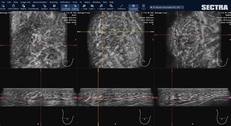 Case Study One For All — Native Support For Automated Breast