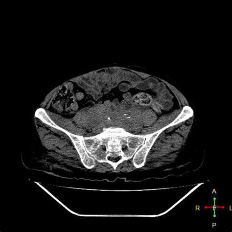 Abdominal Lymphoma Radiology Case