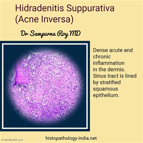Pathology Of Hidradenitis Suppurativa Stratified Squamous Epithelium