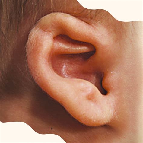 Abstehende Ohren Earwell