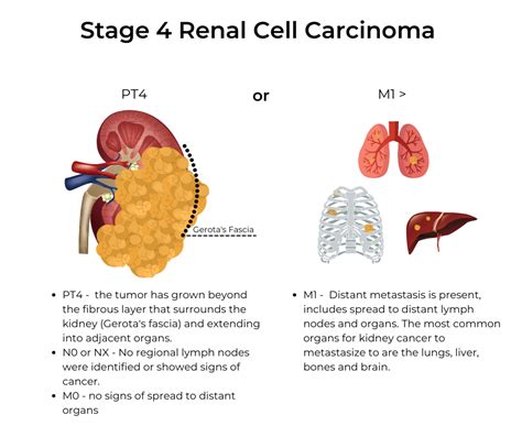 Stage 4 Kidney Cancer Doctorvisit