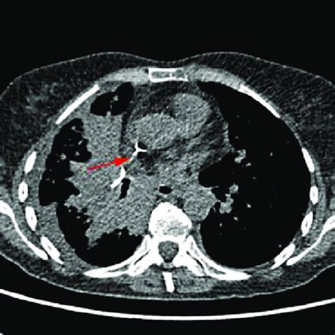 Chest Low Dose Ct Scan Showing A Foreign Body Of Metallic Density Arrow Download Scientific