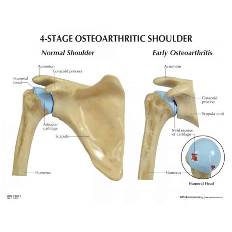 Shoulder Arthritis Mississauga And Oakville Chiropractor And