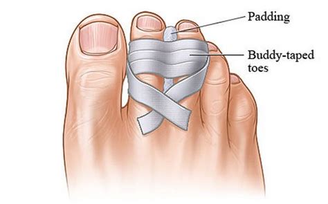 How To Fix A Dislocated Toe At Home Treatment Updated In 2022