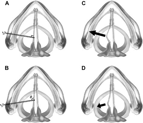 Suture Lateralization In Patients With Bilateral Vocal Fold Paralysis