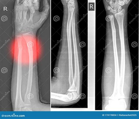 X Ray Image Right Of Wrist Joint Shows Fracture Of The Distal Radius