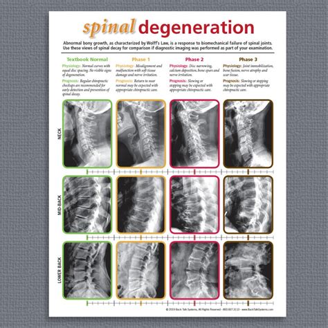 Spinal Degeneration Handout Subluxation Degeneration For