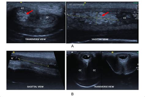 A Transverse And Sagittal Hrus Images Of Penile Shaft Showing