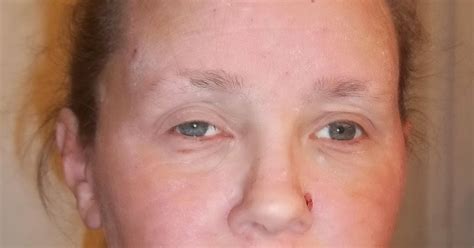Stopping Topical Steroids Pictures Of Recent Flare