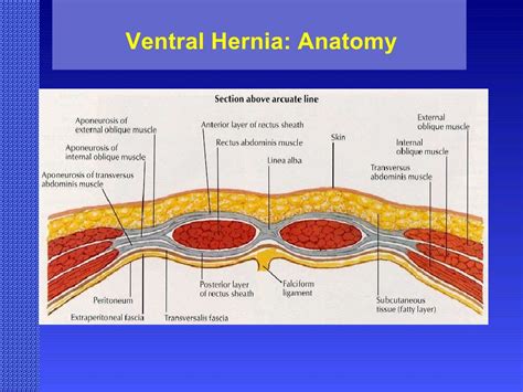 Ventral Hernia Challenges And Choices