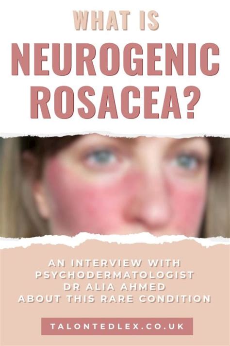 What Is Neurogenic Rosacea Qanda Dr Alia Ahmed Psychodermatologist
