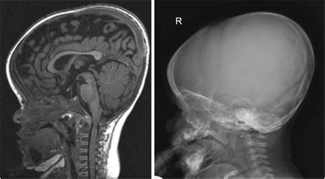 Left The T 1 Weighted Mri Image Of An Infant With Achondroplasia