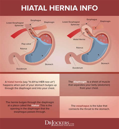 Best Hernia Repair Images Hernia Repair Abdominal Hernia Hernia Hot