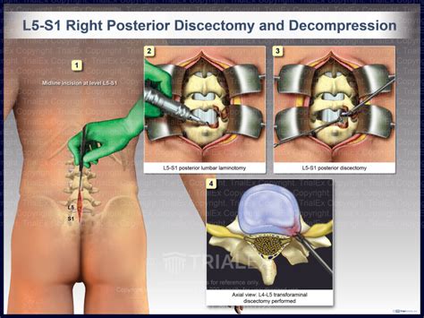 L5 S1 Right Posterior Discectomy And Decompression Trial Exhibi