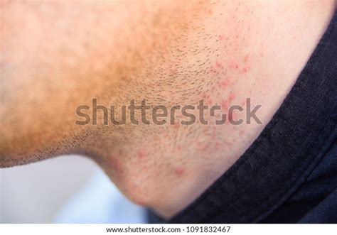 Irritation After Shaving Sores Shaving On Stock Photo 1091832467