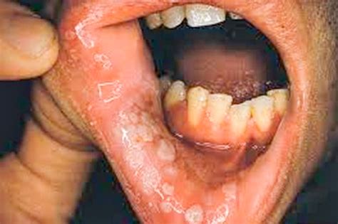 Sexually Transmitted Diseases That Affect The Mouth Searchlight