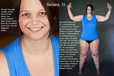 Bei einer fettabsaugung der knie werden am oberschenkel kleine äußere und größere innere fettdepots abgesaugt. Pin auf Lipödem