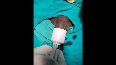 Bhudav Plastic Surgery Clinic Stapler Circumcision Youtube