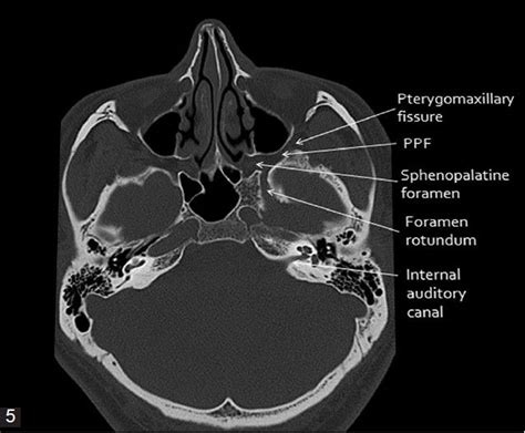  its ability to optimally display bone. Figure 5: Axial CT bone window of skull base from inferior ...