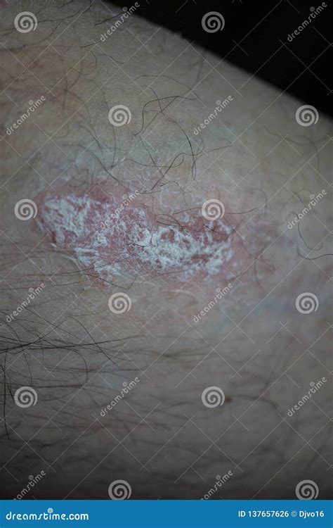 Psoriasis On Knee Of Caucasian Man Dermatological Disease Stock Photo