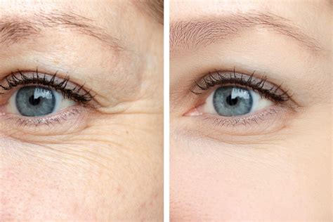 How Do Wrinkles Form Eye Wrinkle Under Eye Wrinkles Eye Wrinkles