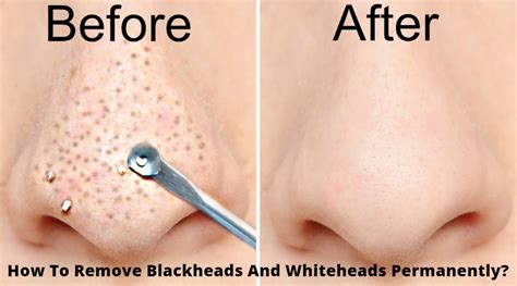How To Remove Blackheads And Whiteheads Permanently Bright Cures