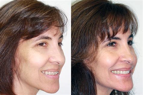 Bite And Face Correction Orthognathic Case Corrective Jaw Surgery