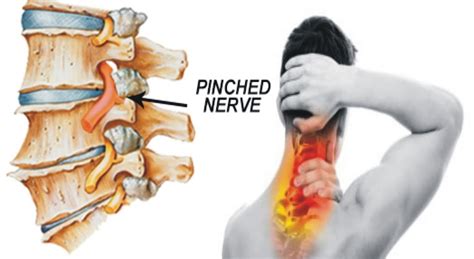 Little Known Questions About If You Have A Pinched Nerve In Your Neck