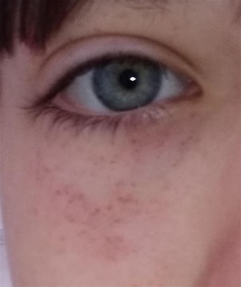 Ive Had These Weird Red Spots Around My Eyes For Two Days Does