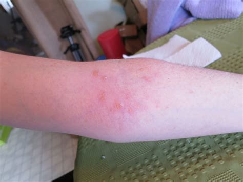 In this page, we have inserted pictures for illustration on how the rash on arms and legs appear. 2013 Photos of Poison Ivy Rashes - Poison Ivy Cures, Help ...