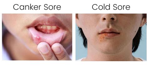 Canker Sore Vs Cold Sore What S The Difference With Pictures — Canker
