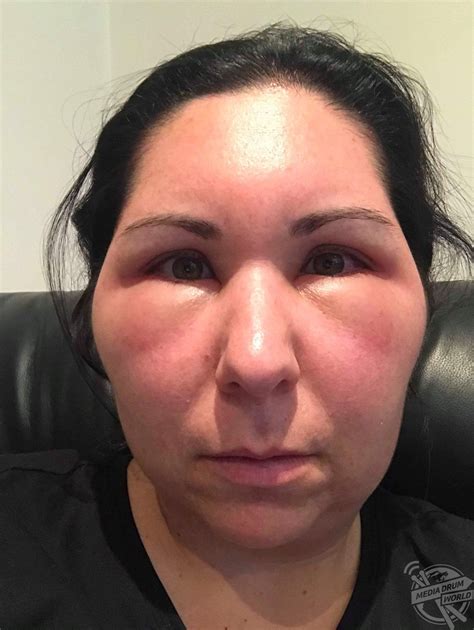 Womans Face Balloons After Severe Allergic Reaction To Hair Dye Leaving Burning Sores On Her