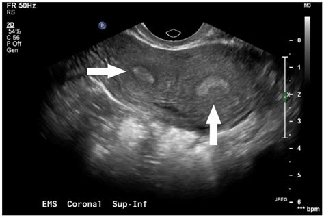 Cervical Ectopic Pregnancy In A 23 Year Old With Uterus Didelphys The