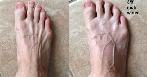 Hyprocure Implant Flat Feet Corrective Surgery 3 Years Later
