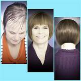 Pictures of New Hair Loss Technology