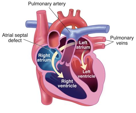 Atrial Septal Defect Buyxraysonline My XXX Hot Girl